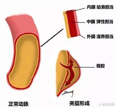 「脂肪酸」48岁男子，背痛了一天，骤然离世，医生措手不及，这病真的太凶险