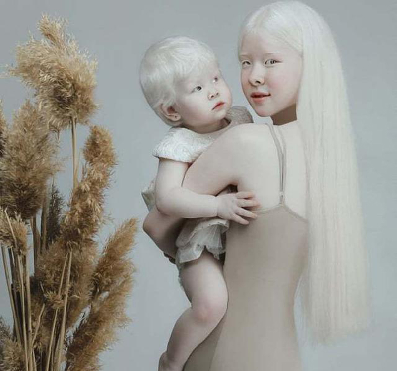 白化病■姐妹俩一出生便“没有颜色”,生活中遭受歧视,如今怎样了?