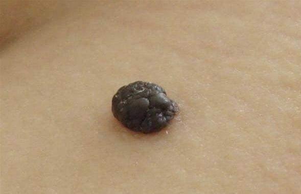 医生|皮肤上的小肉球能抠掉吗？会癌变吗？医生来揭秘了，乱抠早晚出事