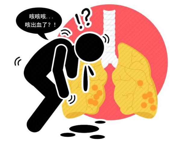 肺癌|肺癌除了胸痛外,若还有这4个表现,警惕癌症已到中晚期