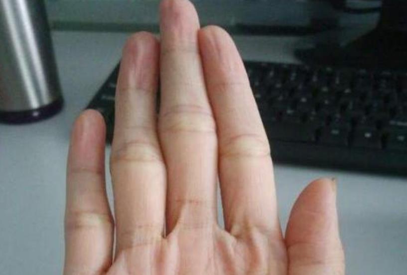 「肝脏」肝脏健康的人,手部一般没这几个表现,一个没中很幸运