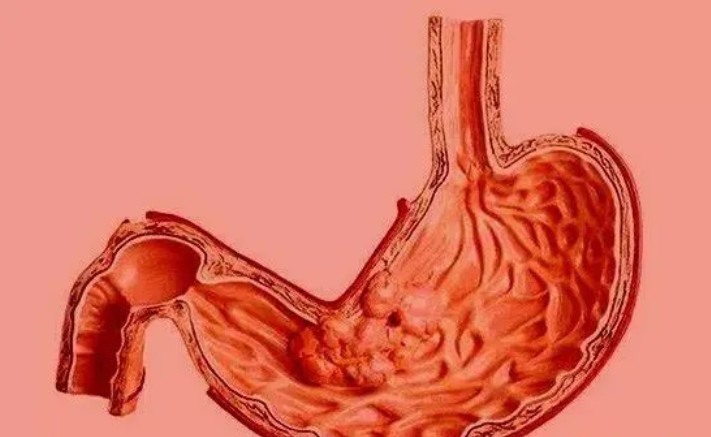 胃病|胃病“最怕”这3种食物，白开水中加一点，健脾养胃，胃病绕道走