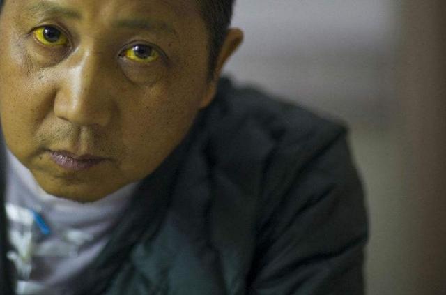 医生|40岁夫妻成\小黄人\，确诊肝癌，医生摇头：与妻子脱不了干系
