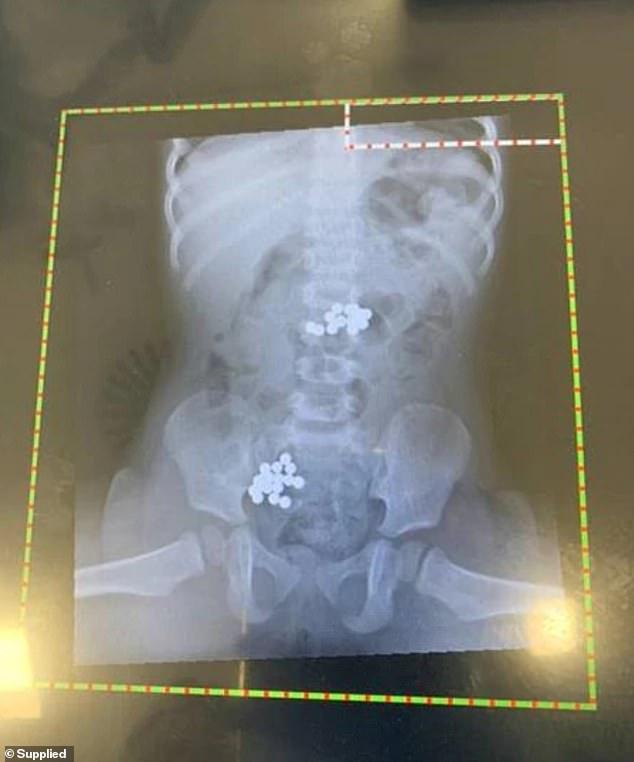 「x光」澳洲一岁女孩腹痛剧烈急做X光，胃和肠道竟查出32个磁铁球