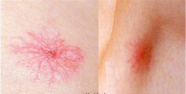 乙肝▲乙肝病毒携带者，出现蜘蛛痣，身体没有症状，这到底是什么原因？