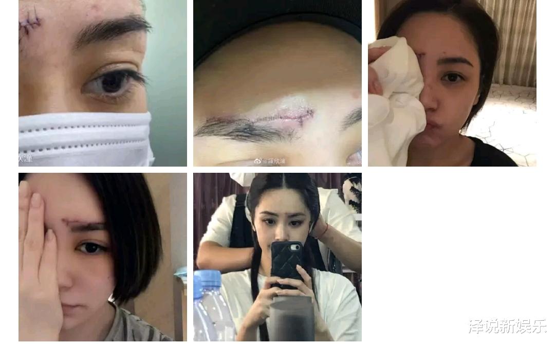 阿娇|阿娇首晒术后照曝好消息，感谢多人却没提周扬青，真因确实无奈