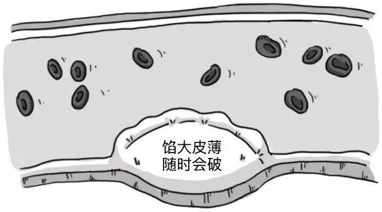 『老年病』好好的血管，怎么说堵就堵？