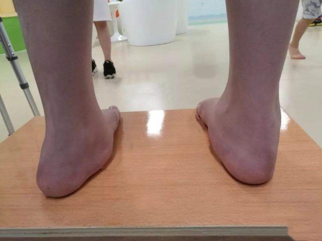 趣观历史|北方小伙不顾父母劝阻，耗费16万成功断骨增高，最后为何又后悔