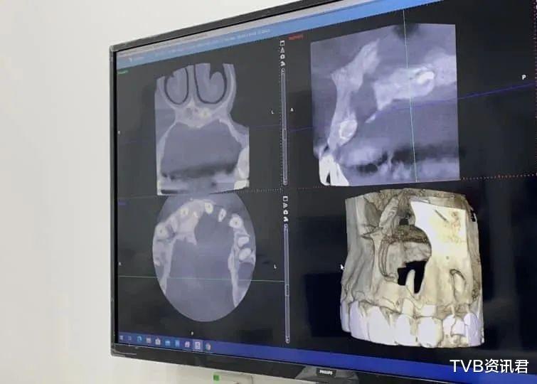 鼻孔下出現大洞！32歲人氣男星緊急入院治療：頭骨已被細菌侵蝕-圖3