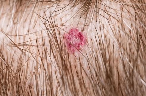 老中医@头皮和后背总是长疙瘩?引起的原因主要有4种,解决的办法全在这