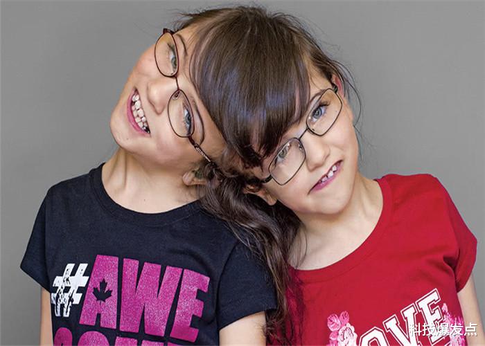 『连体』连体人2个大脑控制一个身体，如果一个去世，另一个怎么办？