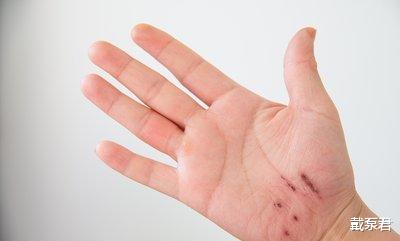 糖尿病▲糖尿病症状只有三多一少吗？NO！这些征兆要小心