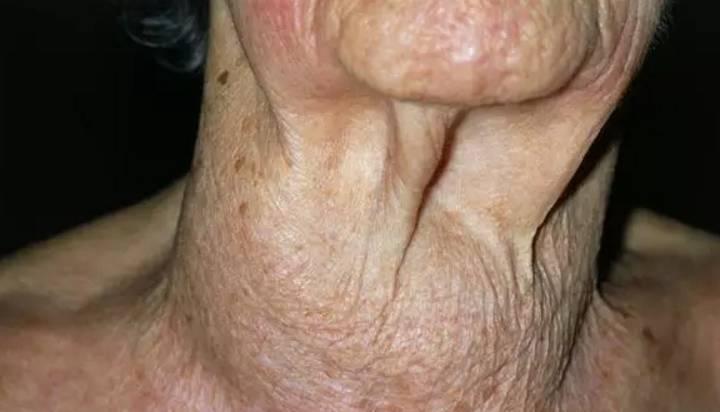 肺癌@5个身体信号,提示你小心肺癌,2大主要因素,明确高危人群