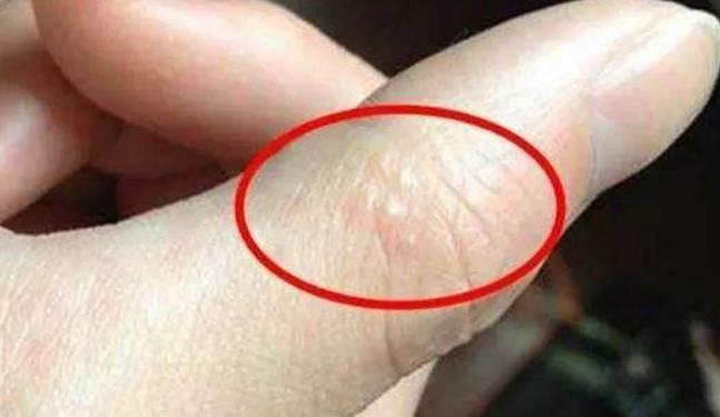 『』天一热,手上就长透明小水泡?不是上火了,其实是“它”在作怪