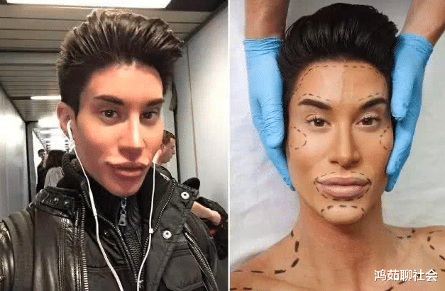 [美国]还记得花154万植入“翅膀”的美国男子，现状如何？网友：人生赢家！