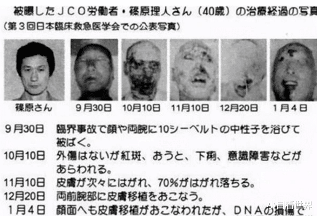 纲手|当一个人全身DNA断裂是什么纲手?一位日本人曾经历过,真的只能等死