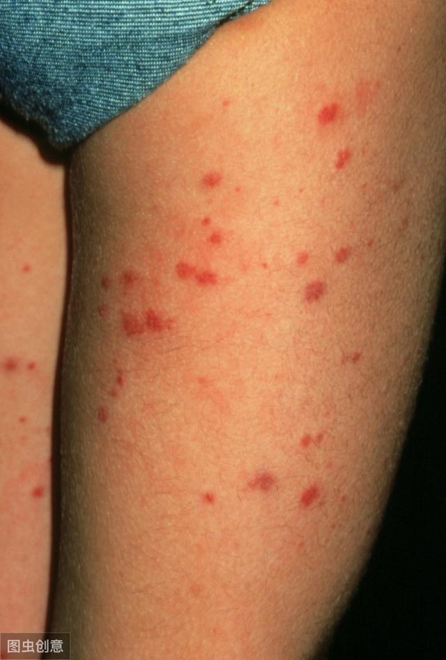 『中药』血小板减少性紫癜,服中药1个月,16年未曾复发