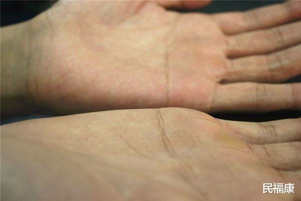 胆固醇|胆固醇是否标准, 伸出手看看就知? 手上无异常，血脂比较稳定