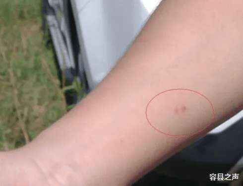容县之声|广西某景区有人刚下车就被蚂蚁咬伤送医抢救，景区：我没责任