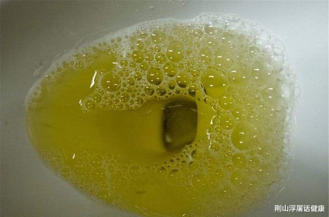 蛋白尿|排尿有泡沫咋回事?泡沫预示有肾脏疾病吗?医生告诉你检查注意