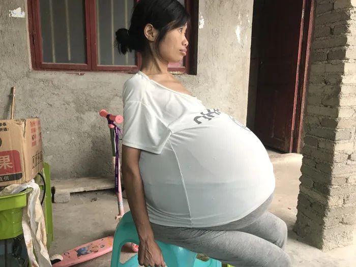 贵州|贵州女子肚子两年疯长成巨球，只能坐着睡觉……