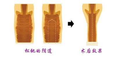 ▲女性私密抗衰该怎么做？