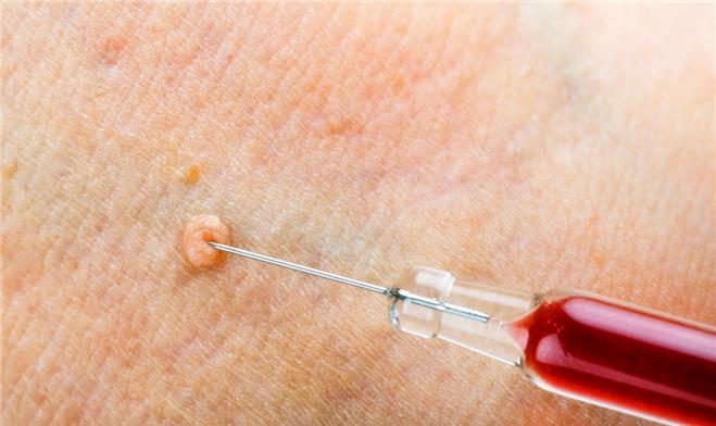 『宫颈癌』警惕:皮肤上长这个“东西”,不是皮肤病,而是感染HPV了,小心