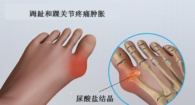 花生|花生嘌呤含量高，痛风患者不宜食用？