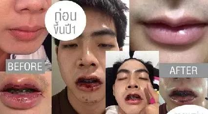 整容|泰国小哥因长太丑花74万整容，成功从丑男变网红