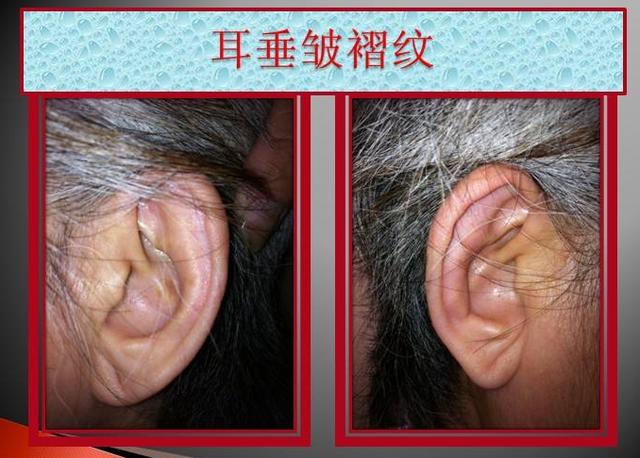 【心脏病】脸上出现4个特征,说明心血管已\堵塞严重\,希望你一个都没有