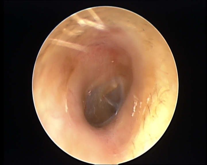 外耳道|小伙享受了次掏耳朵服务，可怕一幕出现：耳朵里布满密密麻麻的…