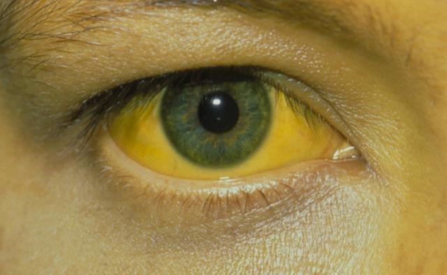 「肝脏」41岁女子，从不喝酒，肝癌离世，医生说：2件伤肝事，害了她