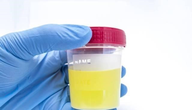 肝脏|晨起有4个异常，八成是肝硬化降临前兆，一个没有，可以偷着乐