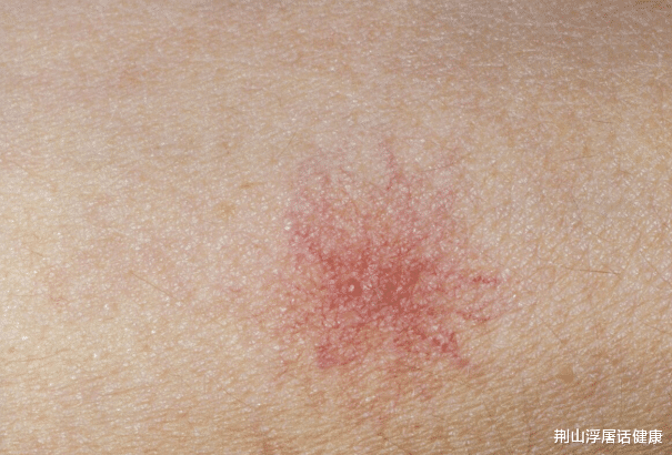 肝脏|肝不好的人，身体会出现“2红、2黑、2黄”，希望你一个也没有