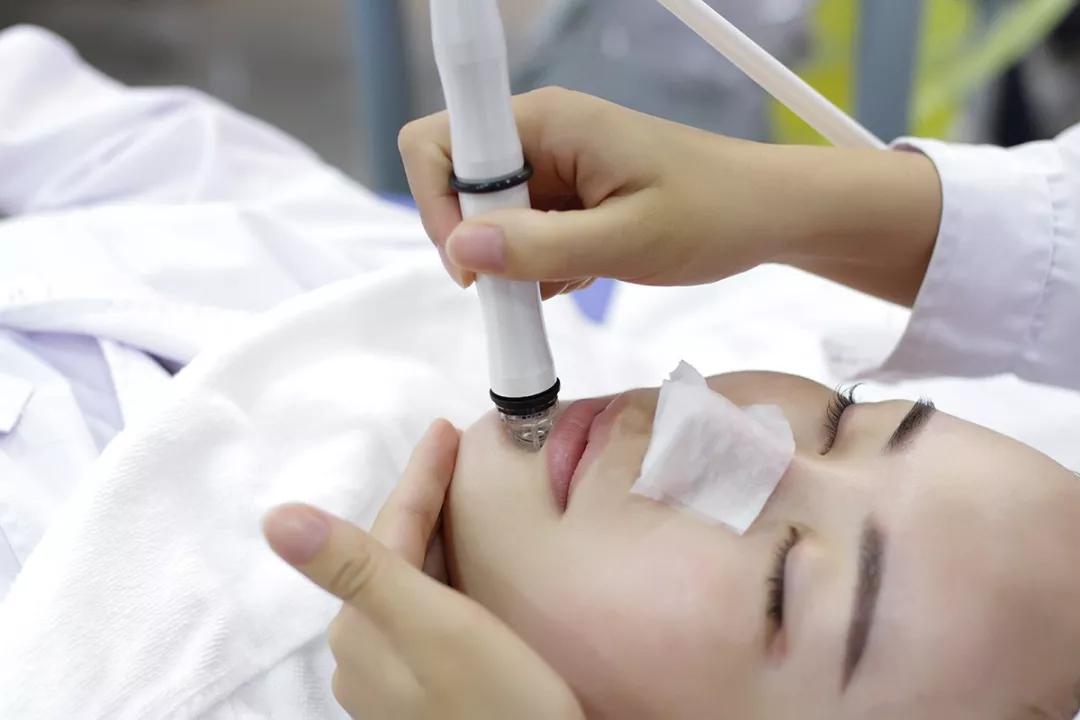 黑头|鼻翼毛孔里的黑色东西是黑头？脂质微丝？