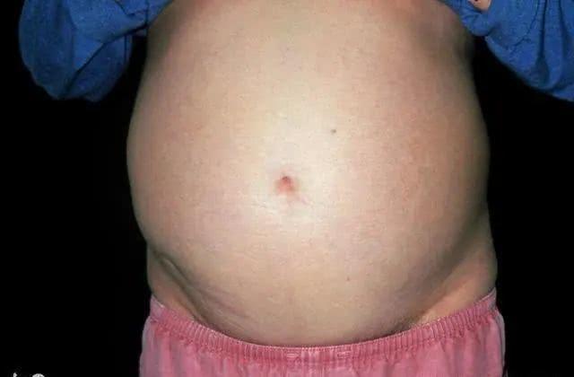 【排便】22岁少女腹大如球，入院就下了病危，父母却痛哭说：不要抢救了