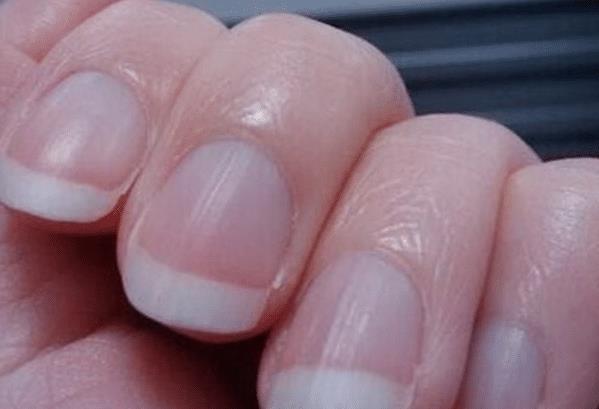 「贫血」指甲上出现竖纹,可能与3种疾病有关,为了健康,不妨提前了解