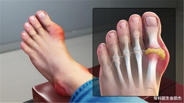 痛风|痛风止痛和降尿酸，吃什么药好？医生清楚告诉您！照着吃，准没错