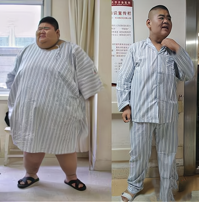 馒头|王浩楠：中国第一胖，一年减掉363斤，因为太胖找不到工作