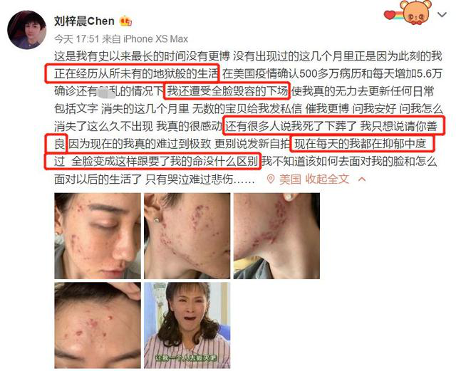 刘梓晨|还记得当年的网红刘梓晨吗?如今的他满脸痘痘,自称毁容!