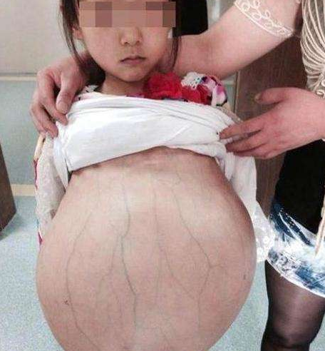 肠胃炎：9岁女孩呕吐不止，宝妈以为是肠胃炎，送医检查后医生：来晚了！