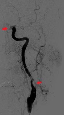 山东商报|?31岁年轻妈妈突发脑梗半身不遂，医生反复追问丈夫还原真相