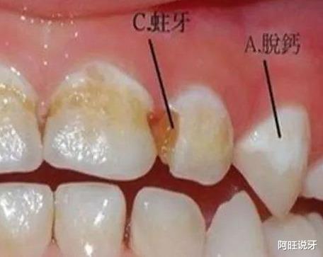 [疾控]虫牙不补可以自愈吗？
