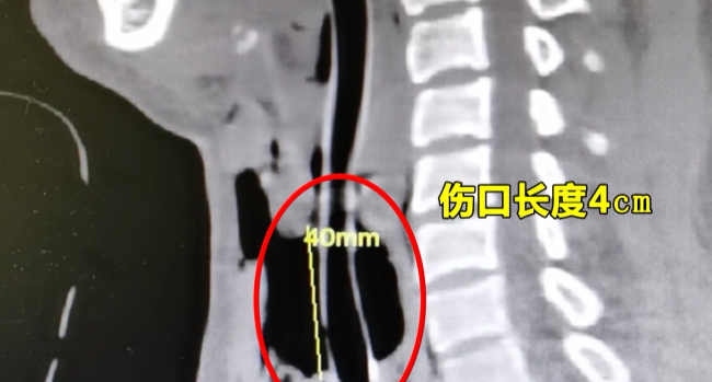 浙样的生活|急寻目击者！杭州一女子骑电瓶车时突遭勒颈，气管被割破