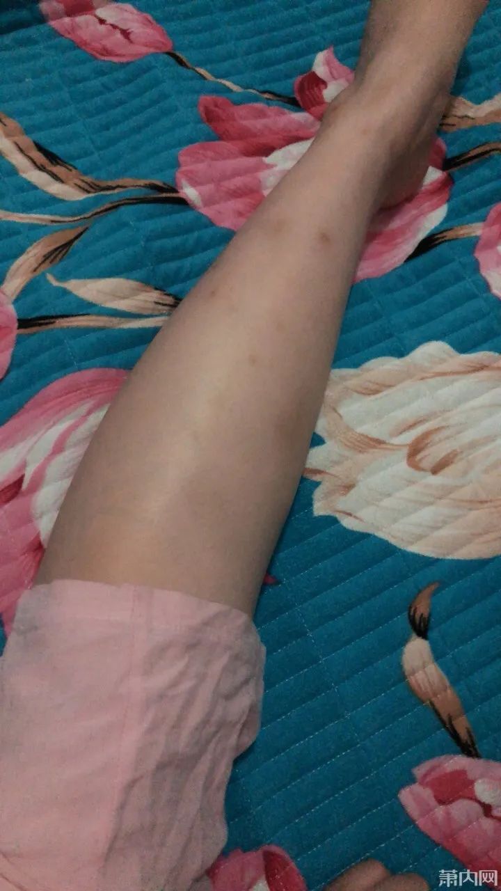 杭州▲杭州一姑娘因为这个小毛病自卑，跟男友坦白还被嫌弃，夏天都不敢穿裙子……