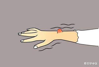 运动|国医大师治包块的方子！化解全身痰核、脂肪瘤、结节，请学习