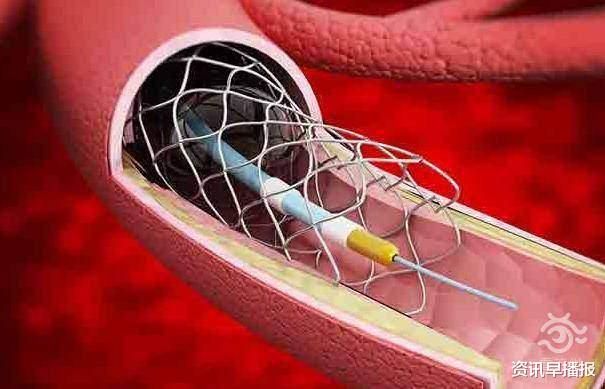 资讯早播报 1.3万降至700元左右！国家集采“冠脉支架”苏州患者用上了