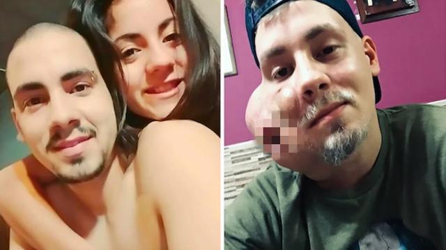 「」阿根廷帅哥脸上长丘疹不在意，谁知竟是癌，瘤体挤压面部容貌尽毁