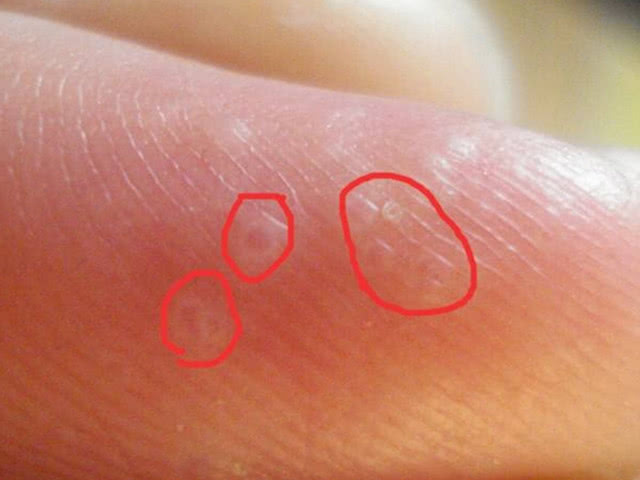 #尿毒症#男生手上“3个征兆”，肾脏8成已超负荷，当心尿毒症来敲门！