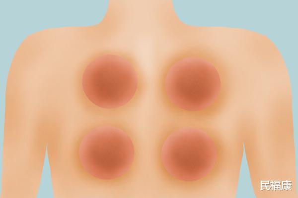 「拔火罐」拔火罐的好处有多少？后背留下的印子，是体内毒素多？涨知识了